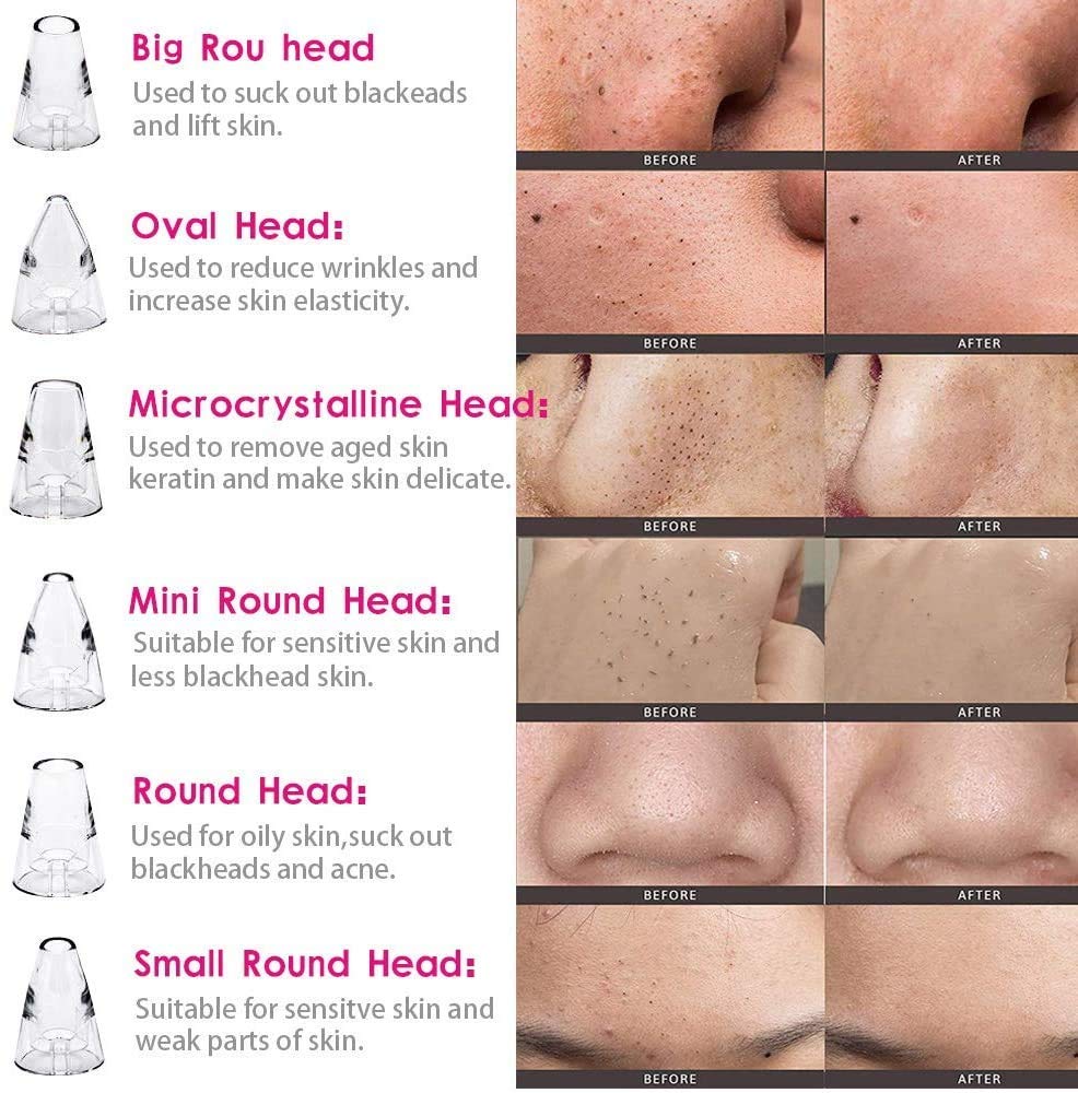 Electric Blackhead Remover