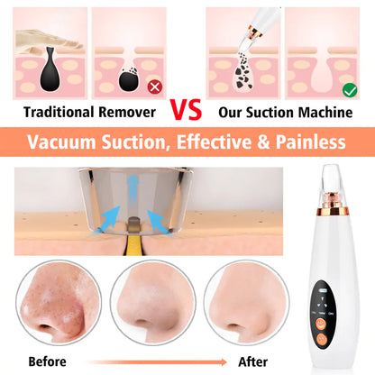 Electric Blackhead Remover